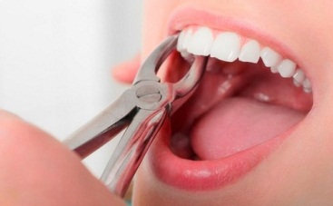 /Data/upload/files/Co-The-Lam-Implant-Ngay-Khi-Nho-Rang-Khong-001.jpg