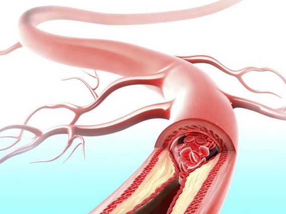 Công thức vàng thông tắc động mạch, ''làm sạch'' mỡ máu