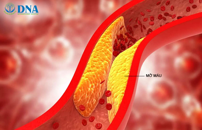 Lọc máu ngừa đột quỵ