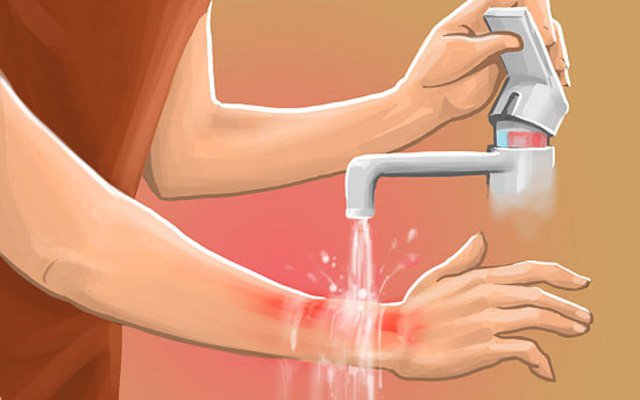 Cách chữa bỏng đơn giản, hiệu quả