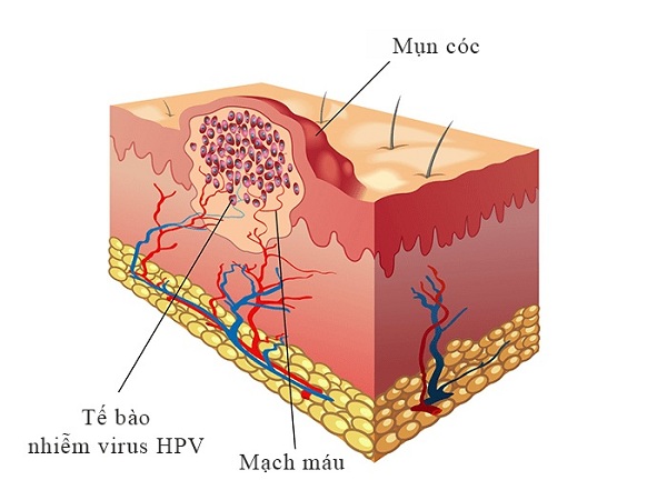 Trị mụn cơm bằng phương pháp dân gian đơn giản, dễ làm lại hiệu quả