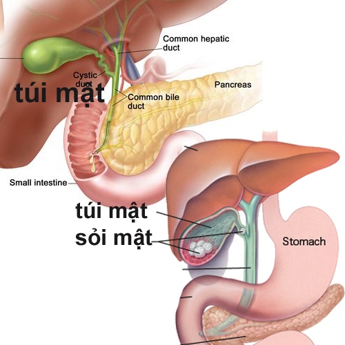 Đánh tan sỏi mật bằng loại quả dân dã không phải ai cũng biết - ảnh 1