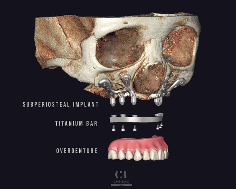 Kỹ thuật Implant cá nhân hoá