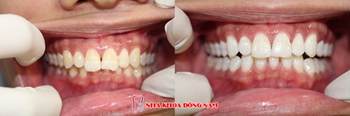 Tẩy trắng răng bằng thẻ bảo hiểm tại nha khoa Đông Nam