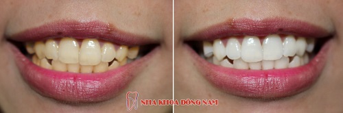 Tẩy trắng tăng bằng công nghệ đèn zoom hiện đại