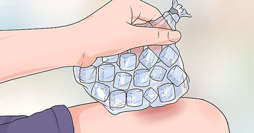 chườm đá chữa bỏng
